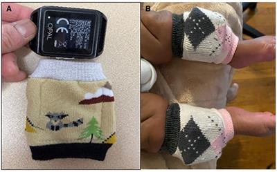 Locomotor learning in infants at high risk for cerebral palsy: A study protocol